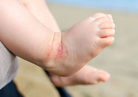 脚踝婴儿湿疹位置图片