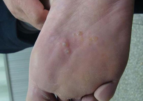 水疱型脚癣图片和症状