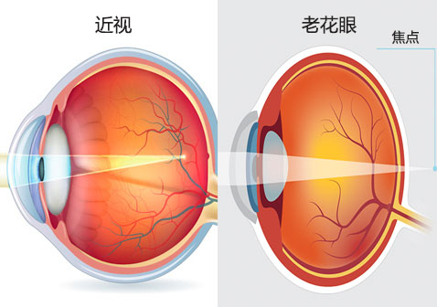 近视和老花眼的区别对比图片