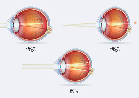 近视和散光的区别对比图片