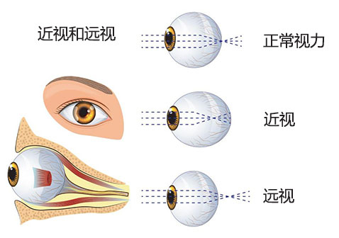 近视和远视的区别有什么对比图片