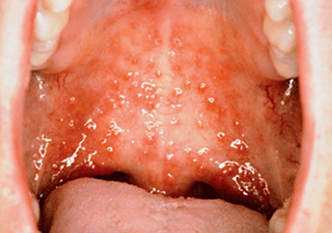 口腔疱疹症状图片2
