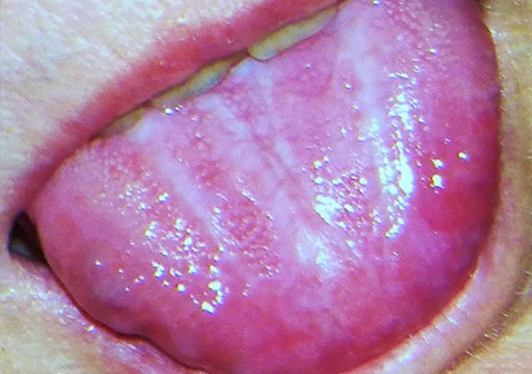 口腔苔藓症状舌头图片
