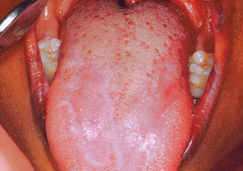 口腔苔藓症状图片