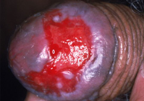 糜烂性包皮龟头炎症状图片对照