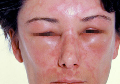 面部急性荨麻疹血管性水肿图片