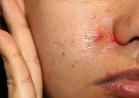 面部结节型痤疮痘痘图片