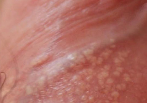 男性生殖疱疹症状图片4