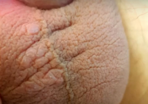 男性阴囊湿疹初期图片