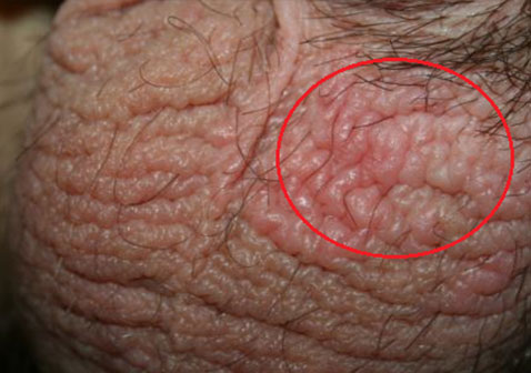 男性阴囊湿疹初期症状图片