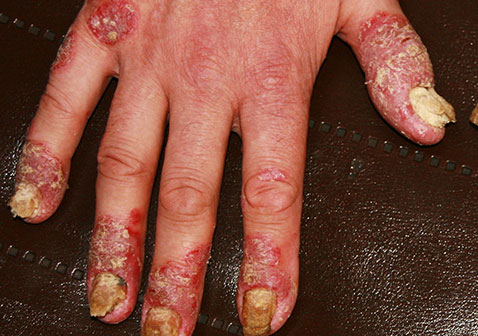 指甲牛皮肤癣的症状图片