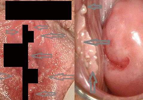 女性尖锐湿疣初期图片