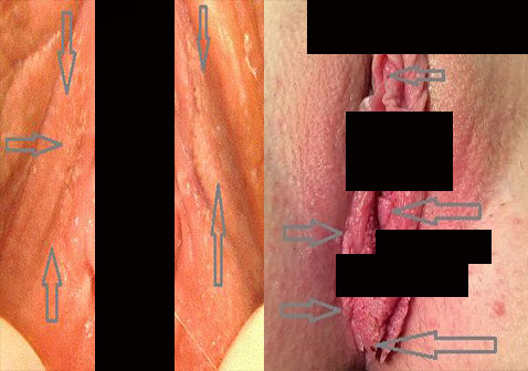 女性尖锐湿疣症状图片