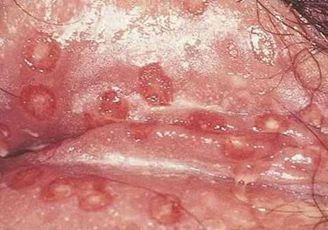 女性生殖器疱疹症状图片