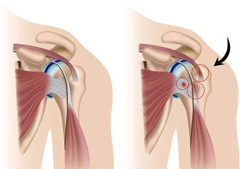 女性强直性脊柱炎早期症状表现图片肩关节疼痛