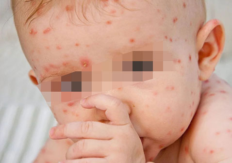 疱疹有几种类型图片水痘