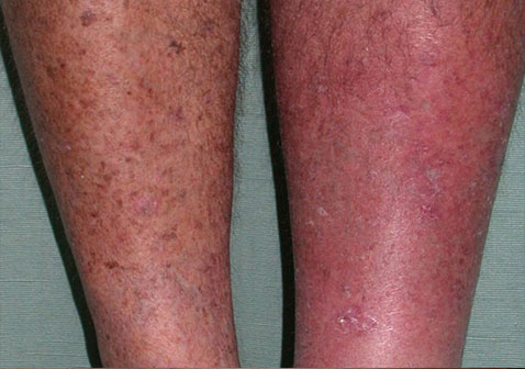 人体100种皮肤病对照图片蜂窝织炎症状