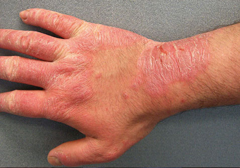 皮肤病图片对照查看图片大全-接触性皮炎症状图片