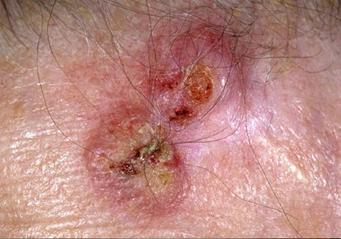 人体100种皮肤病对照图片鳞状细胞癌