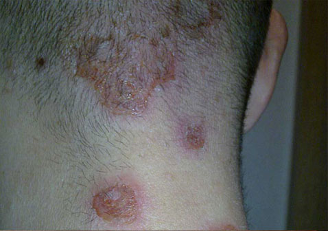 人体100种皮肤病对照图片脓疱疮