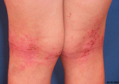 皮炎性湿疹是什么原因造成的图片