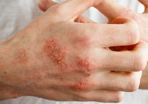 鳞屑皮肤病图片湿疹