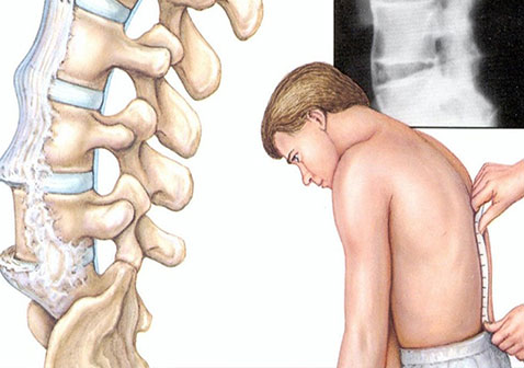 强直性脊柱炎的早期症状僵硬图片