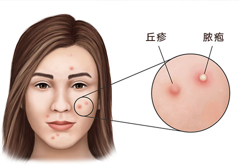 丘疹性痤疮和脓疱对比图片