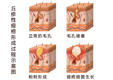 丘疹性痤疮痘痘形成过程图片