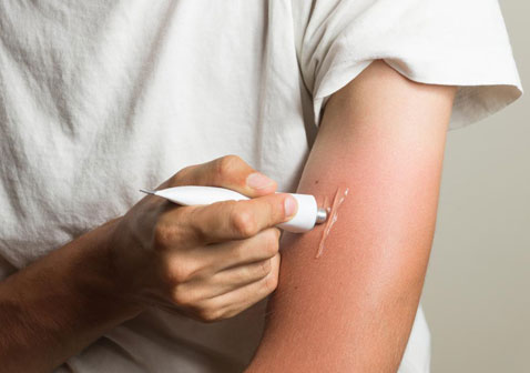 丘疹性荨麻疹根治方法图片
