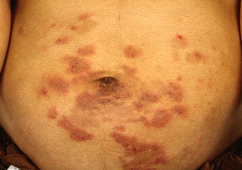 妊娠痒疹症状图片