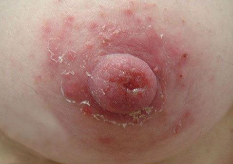 乳房湿疹图片