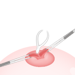 乳头内陷矫正手术乳管切开法过程图片2
