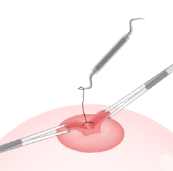 乳头内陷矫正手术乳管切开法过程图片3