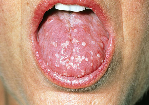 舌头疱疹症状图片2