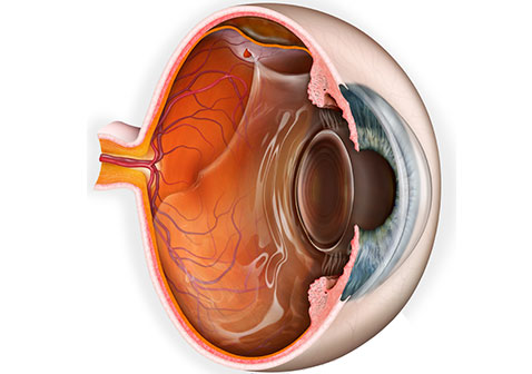 视网膜脱落3D图片