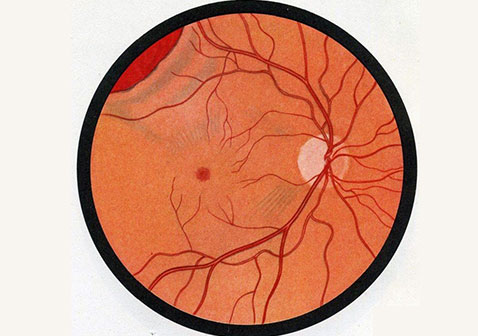 视网膜脱落的初期症状图片黑点和闪光