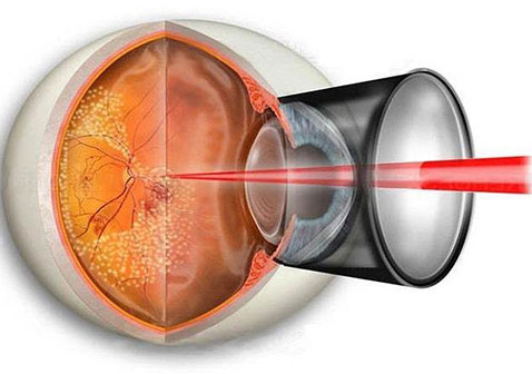 视网膜脱落激光治疗图片