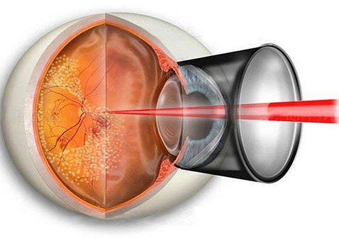 2021视网膜脱落怎么治疗最好：激光手术治疗