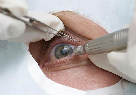 视网膜脱落手术图片