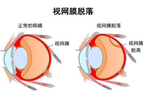 正常眼睛和视网膜脱落对比图片