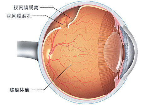 视网膜脱落严重吗