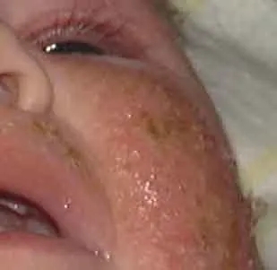 食物过敏导致的婴儿皮炎湿疹症状图片