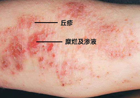 湿疹的症状图片2