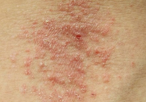 湿疹和过敏性皮炎的区别对比图片
