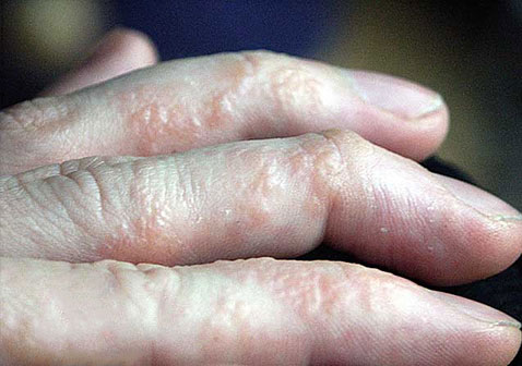 常见皮肤病图片及名称湿疹