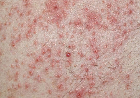 湿疹类型-接触性湿疹症状图片