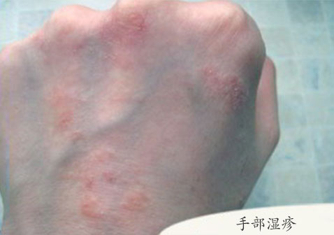 湿疹类型-手部湿疹症状图片