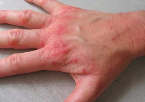 手背慢性湿疹图片