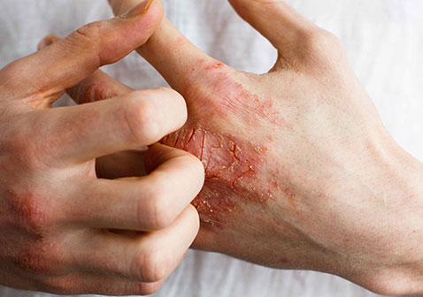 手部大人接触性湿疹症状图片